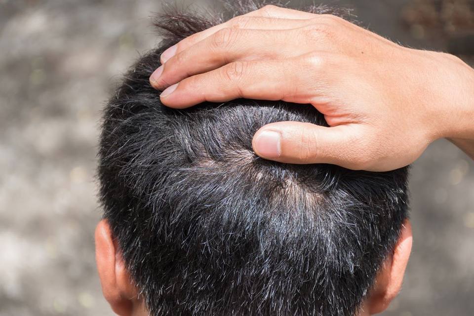 Scalp Micropigmentation for Men in Atlanta – Permanent Makeup of Atlanta: smp men img2