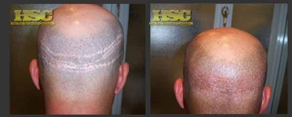 SMP for Hair Transplant Scars – Permanent Makeup of Atlanta: smp transplant2