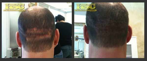 SMP for Hair Transplant Scars – Permanent Makeup of Atlanta: smp transplant3