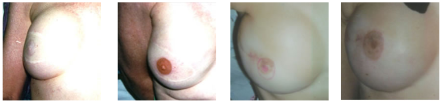 Areola1