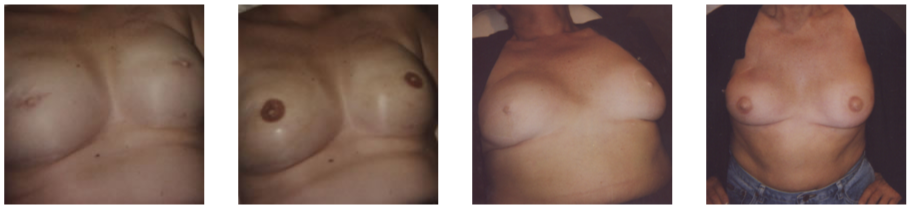 Areola2
